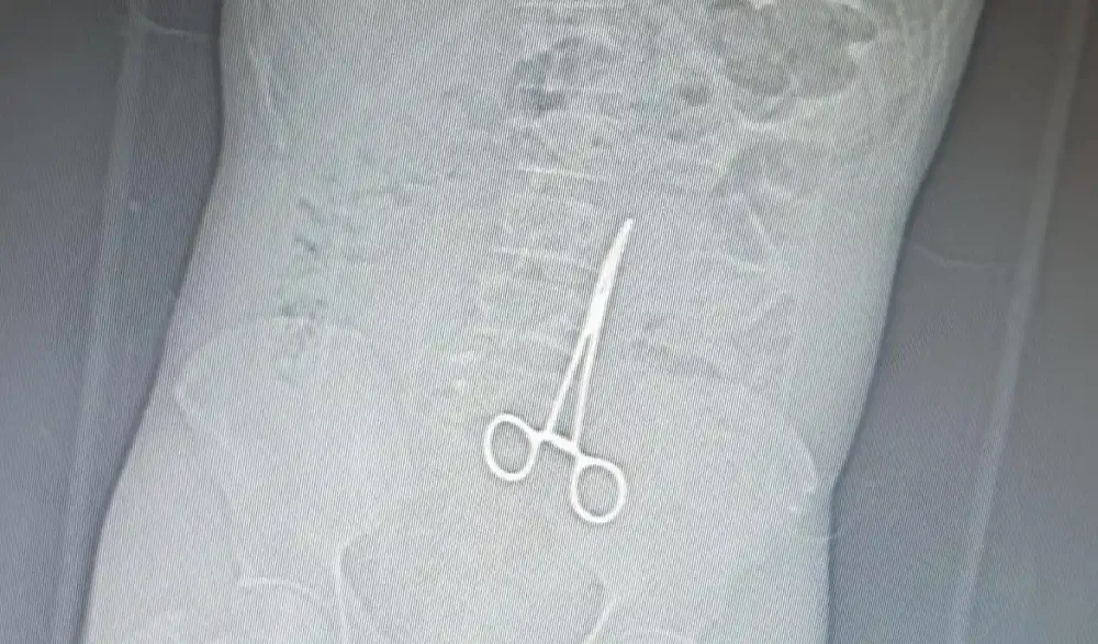 PARAUAPEBAS: Paciente vai à UPA e descobre pinça esquecida no abdômen