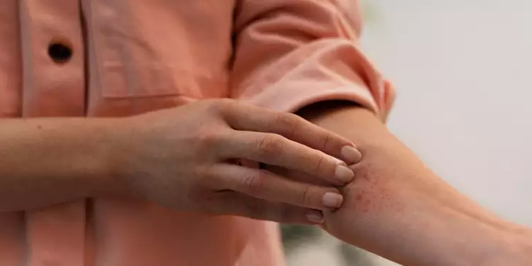 Cobreiro é herpes-zóster? Veja o que é a doença, sintomas e tratamento