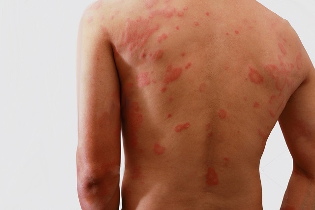 Janeiro Roxo: Canaã inicia ações de prevenção à hanseníase nesta quinta (19)