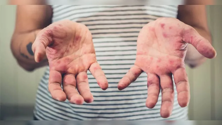 Ministério da Saúde confirma dois casos de sarampo no Brasil