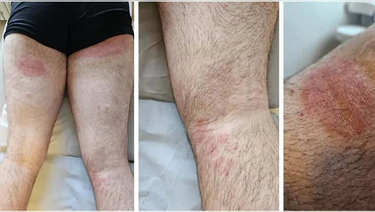 Fungo resistente a antifúngicos tem primeiro caso no Brasil