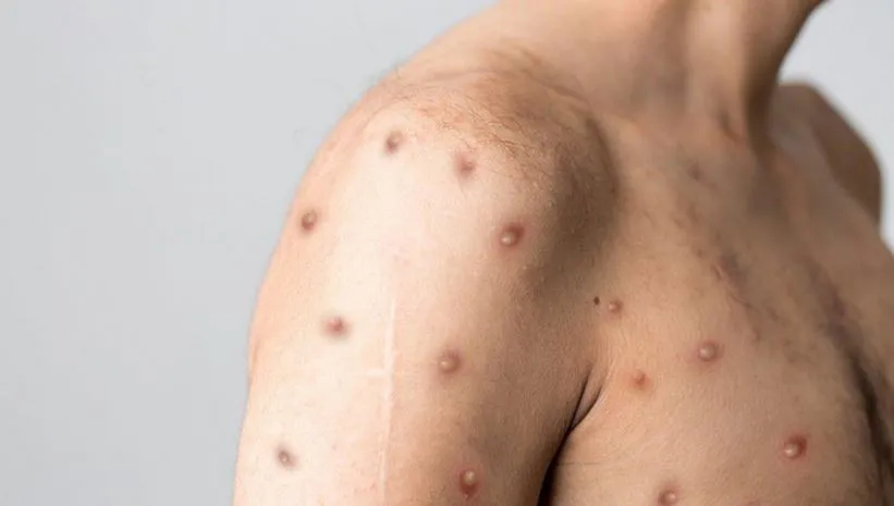 Pará registra 19 casos de Mpox; Canaã dos Carajás se prepara para atender casos suspeitos