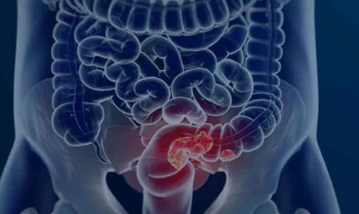 Estudo projeta aumento de 36% em mortes por câncer colorretal até 2040