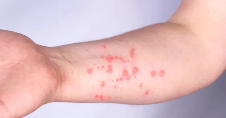 Sobe para 140 número de casos confirmados de Mpox no Brasil