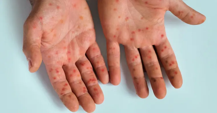 Mpox tem cura? Como identificar? Veja as principais dúvidas