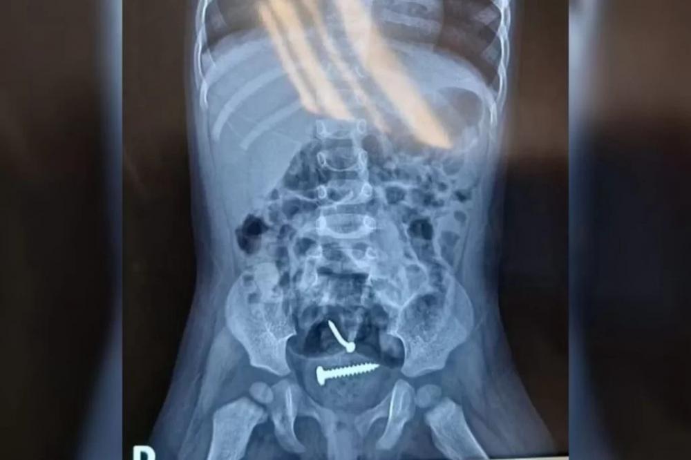 Parafusos são encontrados dentro de criança estuprada pelo pai no PI